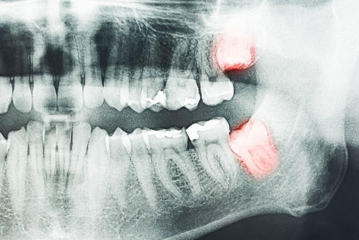 Wisdom Tooth Removal: Facts You Need To Know