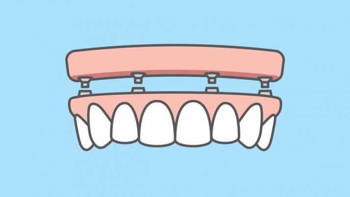 Are All-On-4 Dental Implants Right for Me?