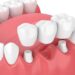 dental crown implant