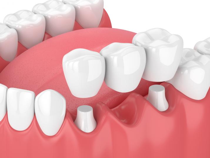 Dental Crowns, Bridges, or Implants: Which is the Right Choice for Me?