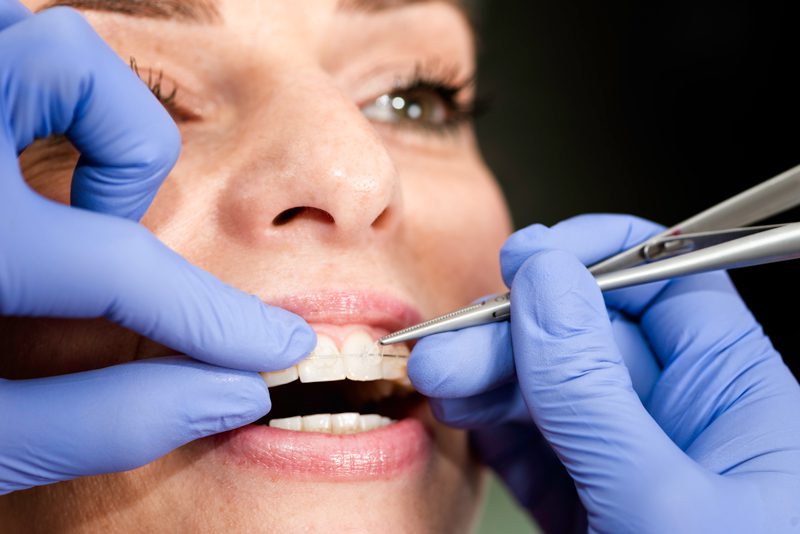 dental-braces-being-put-on