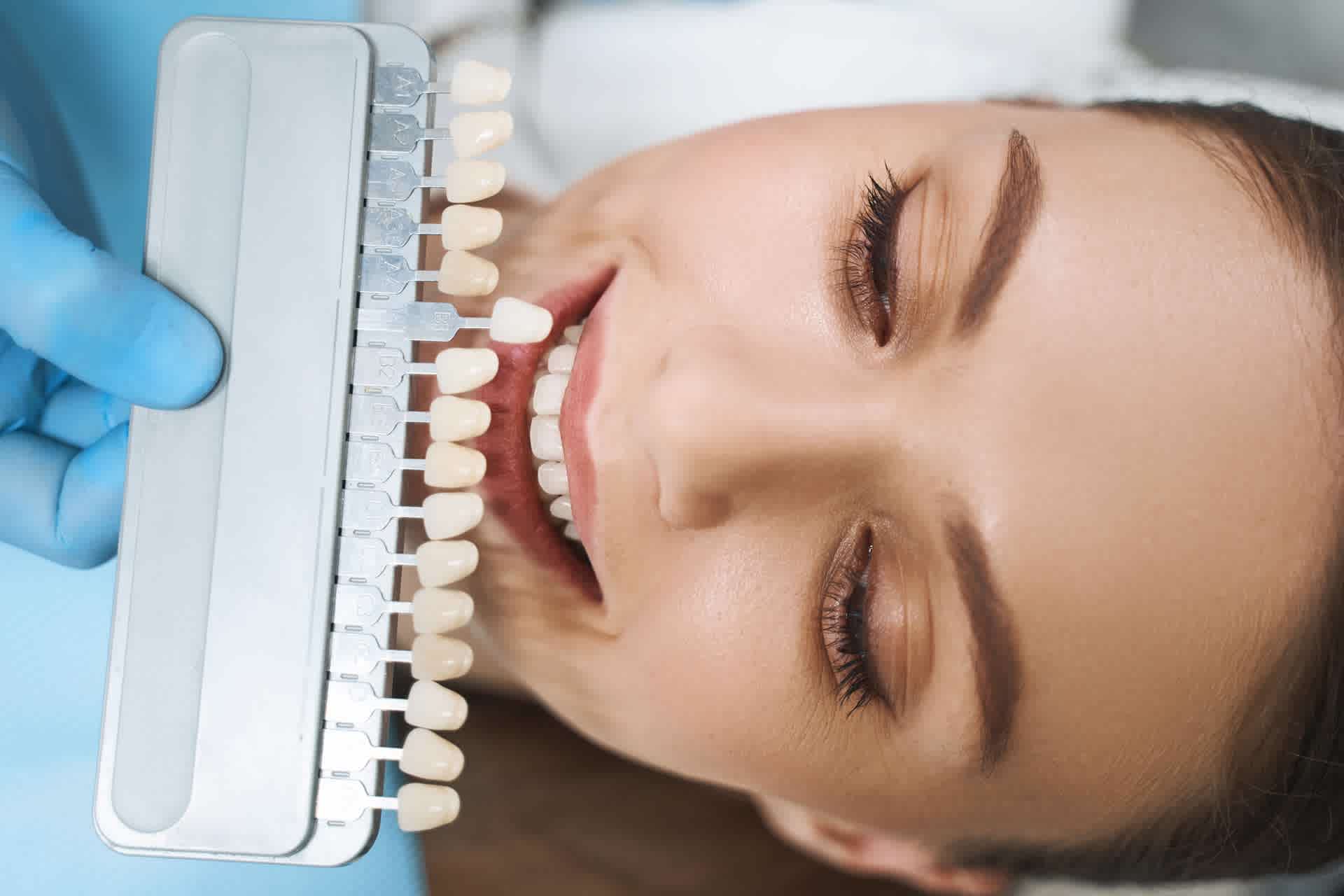 Why Teeth Whitening Should Be Done In A Clinic