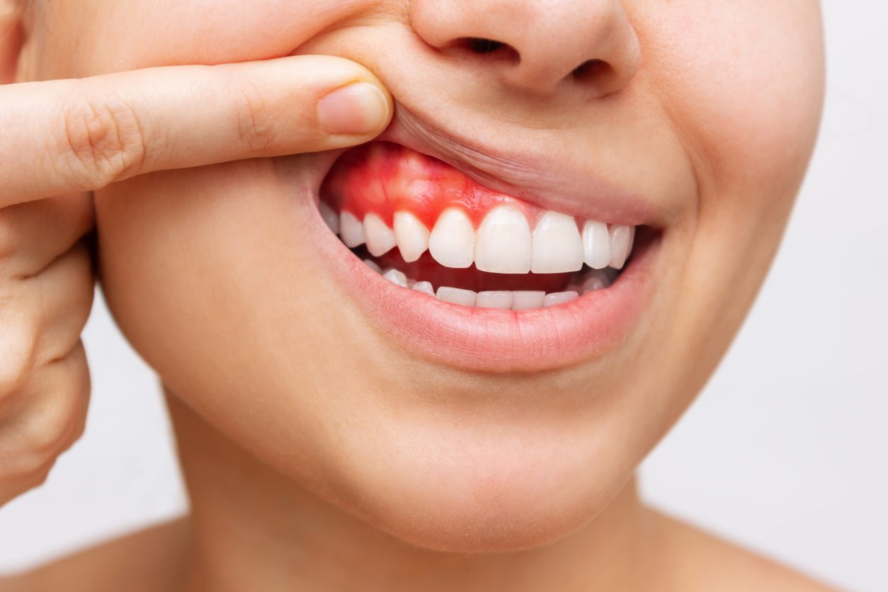 3 Factors That Contribute To Gum Recession