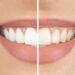zoom whitening