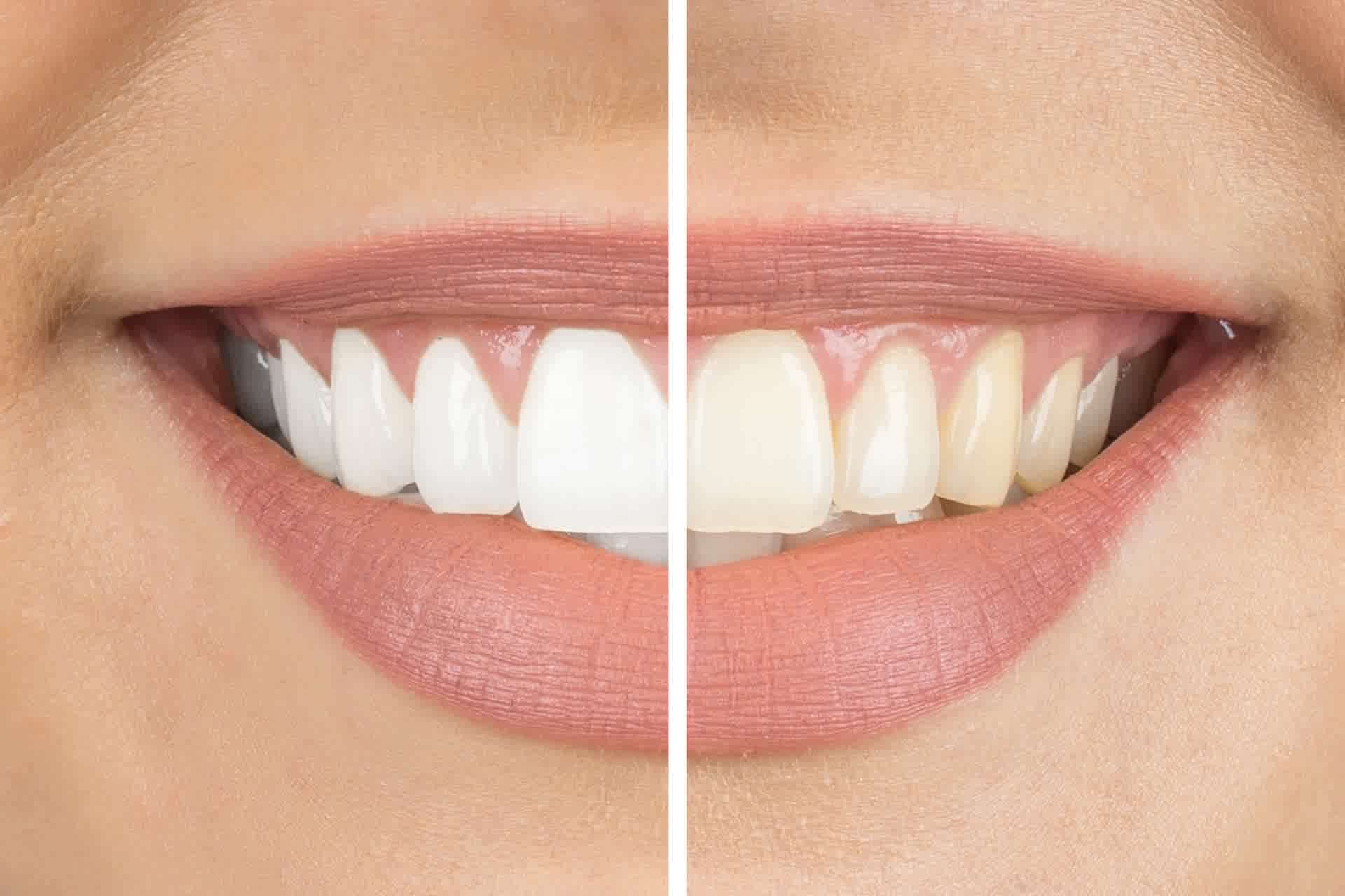 How Does Teeth Whitening Work?