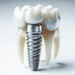 dental implants