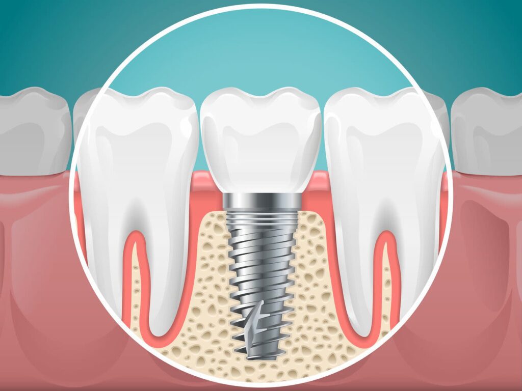dental-implant-illustrated