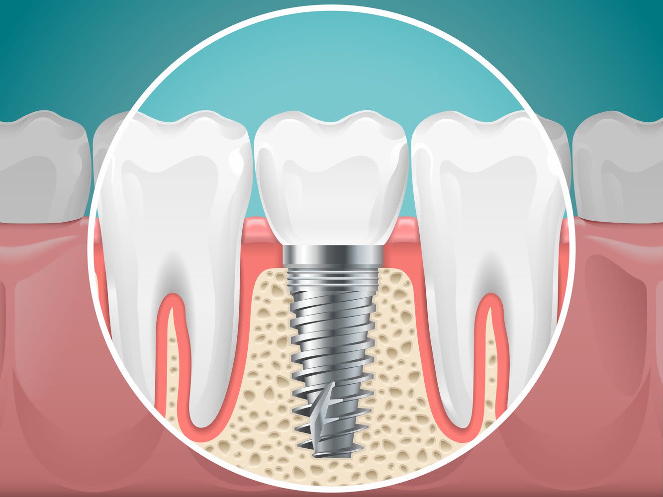 dental-implant-illustrated
