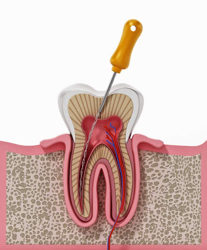 root-canal-treatment-illustrated