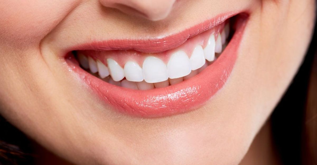 Smile Makeover