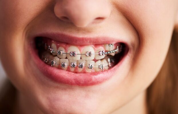 How Do Dental Braces Correct Bite Alignment Over Time?