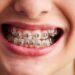 Braces