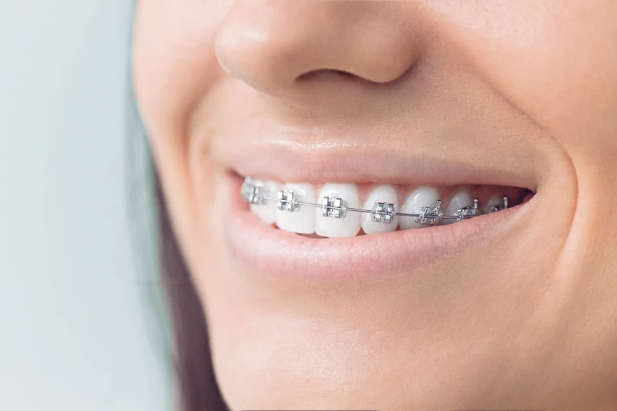 dental-braces-banner
