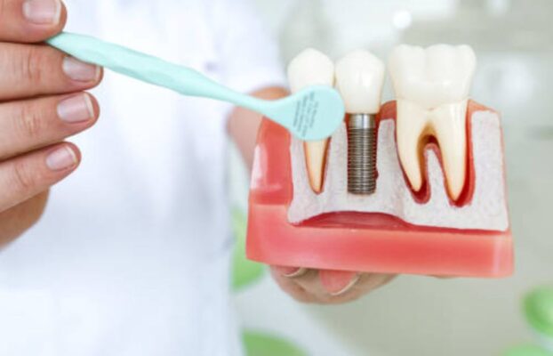 Can Dental Implants Feel Like Real Teeth?