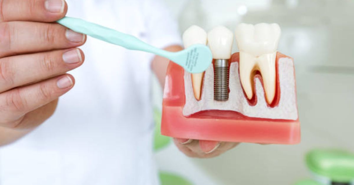 Can Dental Implants Feel Like Real Teeth?