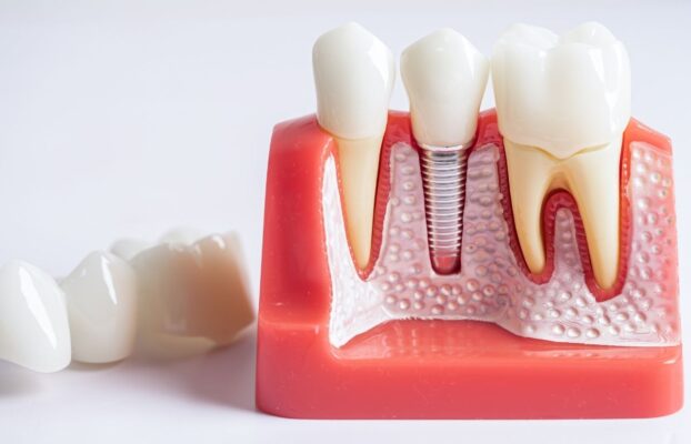 Can Dental Implants Prevent Jawbone Shrinkage?