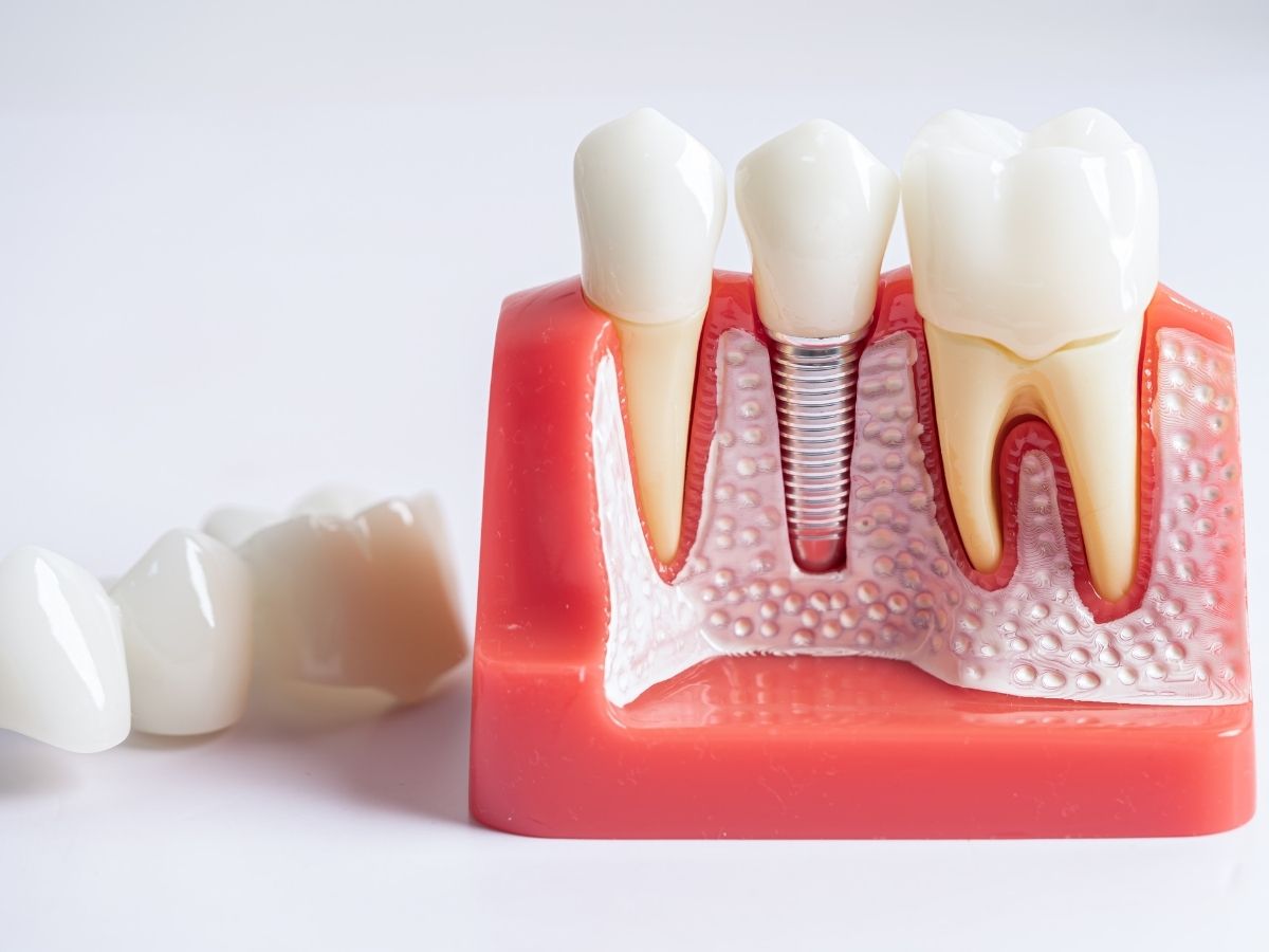 Can Dental Implants Prevent Jawbone Shrinkage?