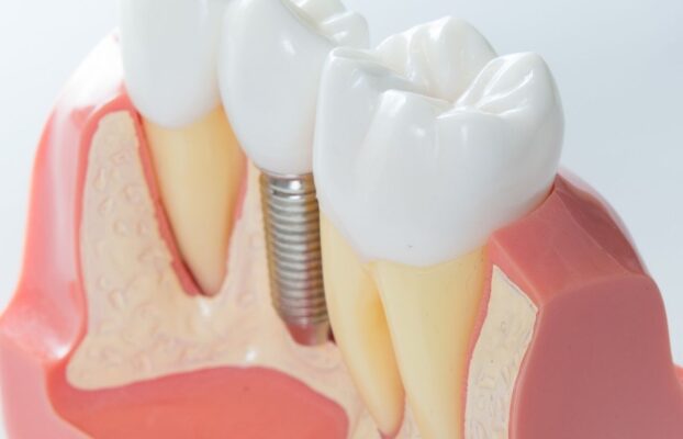 How Do Dental Implants Help Replace Missing Teeth?