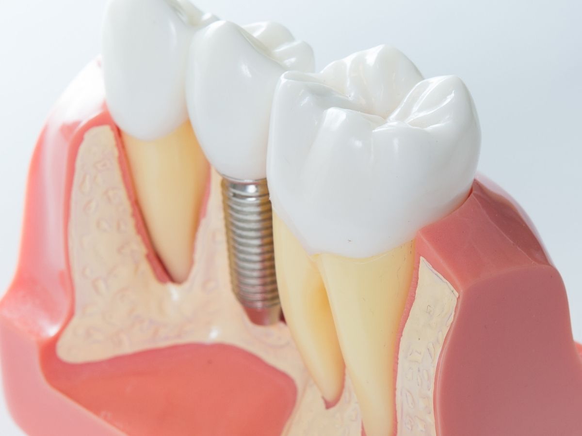 How Do Dental Implants Help Replace Missing Teeth?
