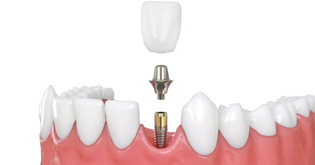  Dental Implants