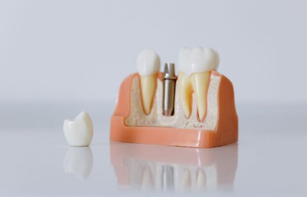 Can Someone With Low Bone Density Still Get Dental Implants?