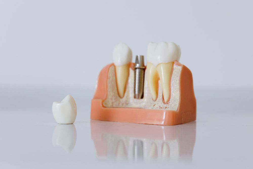 Can Someone With Low Bone Density Still Get Dental Implants?