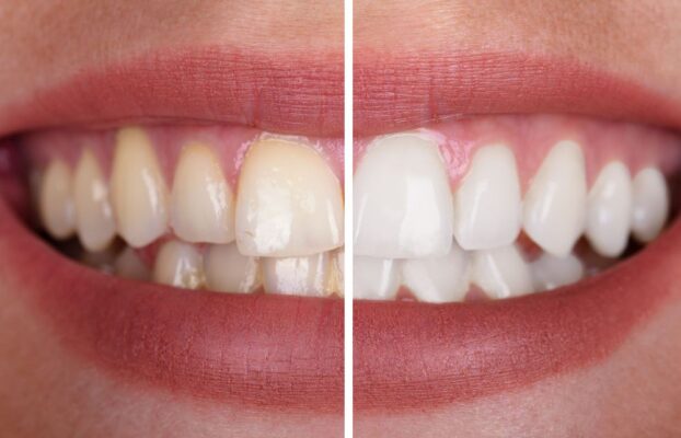 Teeth Whitening Myths That Could Be Damaging Your Smile