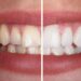 Teeth Whitening