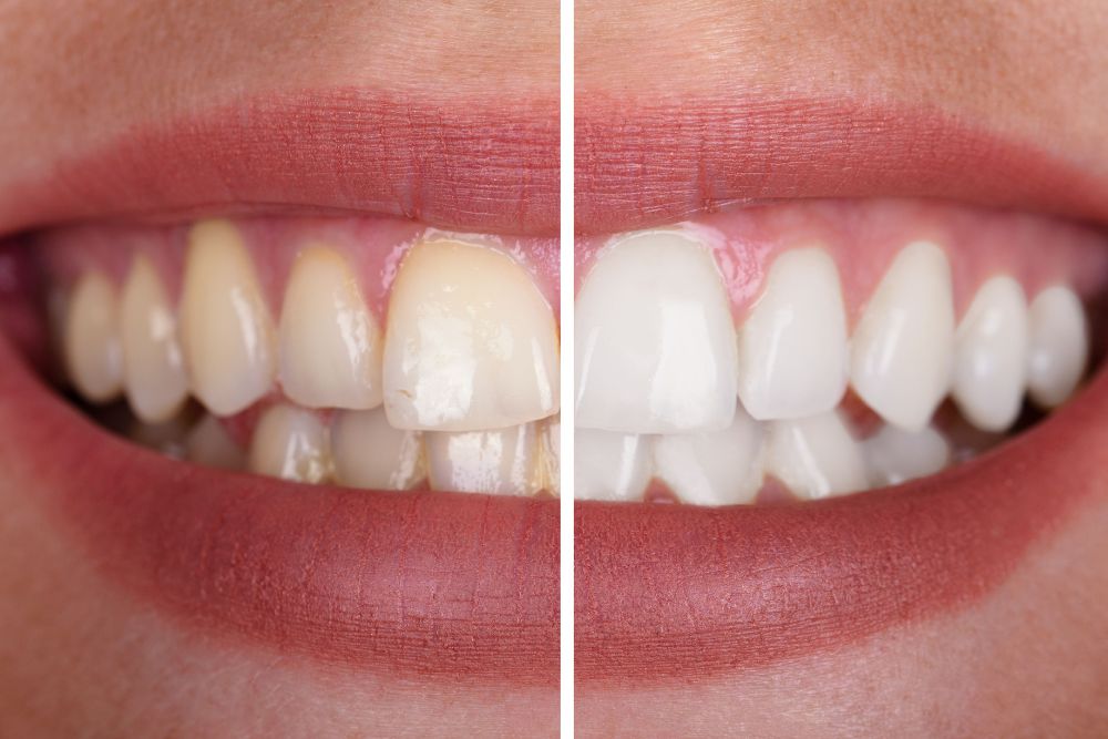 Teeth Whitening Myths That Could Be Damaging Your Smile